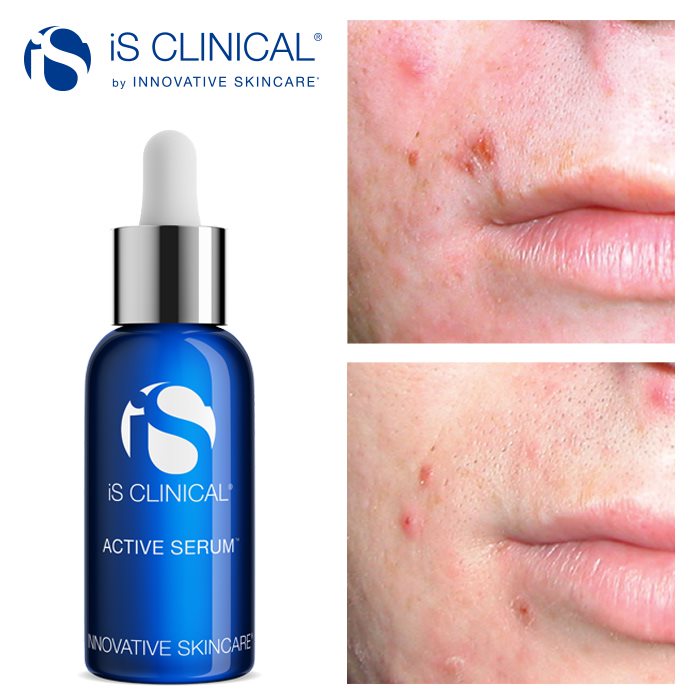 iS Clinical Active Serum